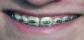 Braces eventually create a beautiful smile